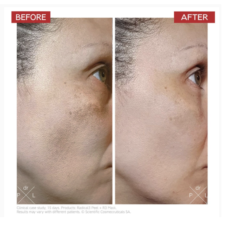 RADICAL3 REBOOT PRO PEEL - EXFOLIAČNÍ PEELING 50 ml