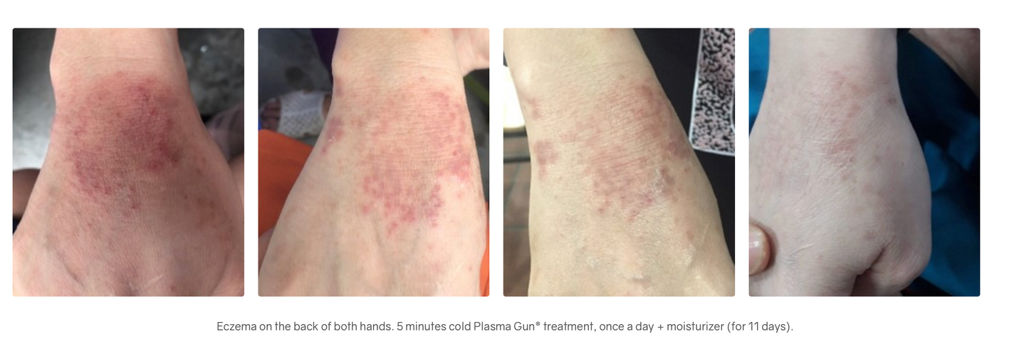 PLASMA GUN® pouze na objednávku